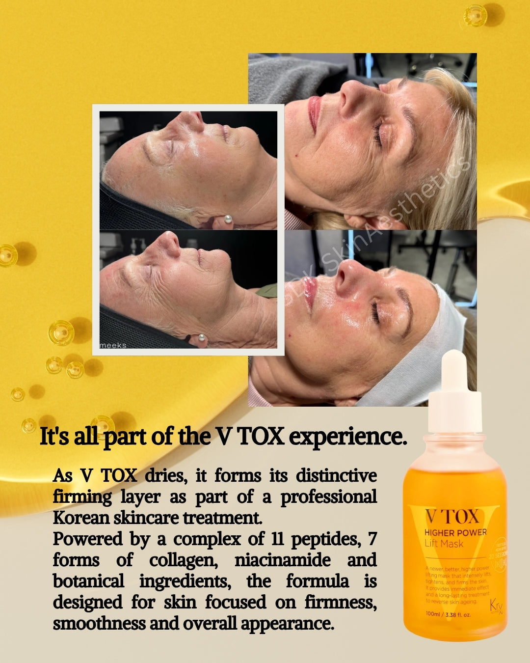 KRX V-TOX promotional photograph 2