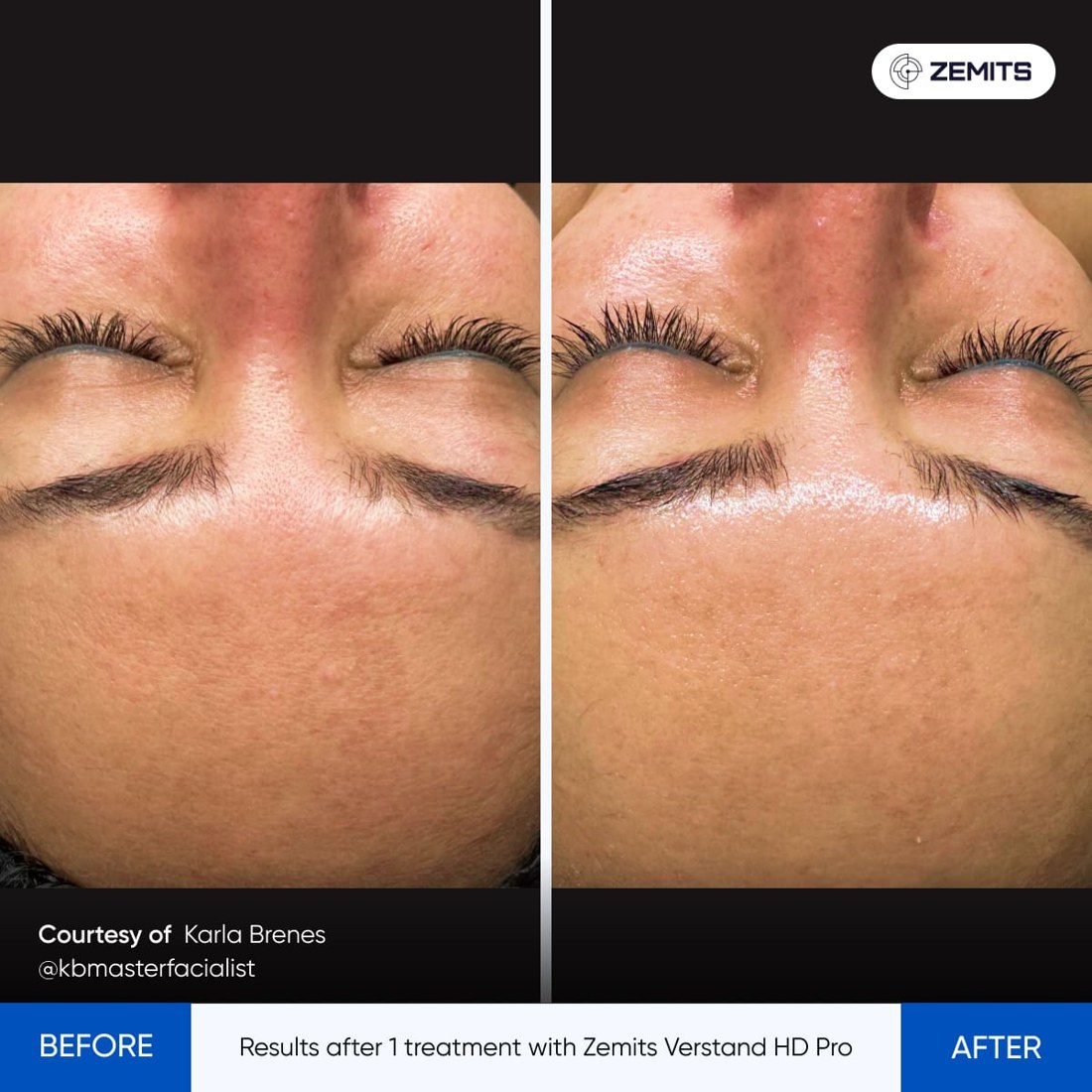 Zemits supplied before and after comparison: 1 treatment
