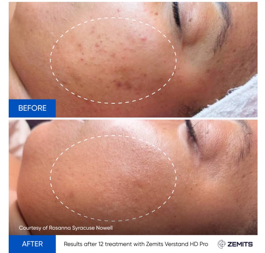 Zemits supplied before and after comparison: 12 treatment