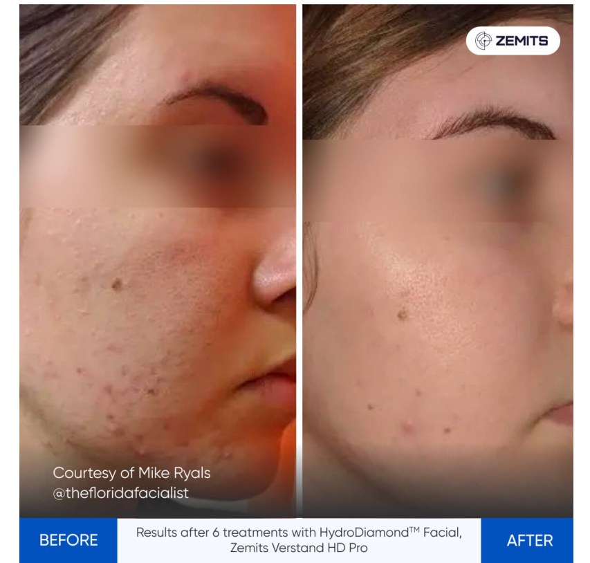 Zemits supplied before and after comparison: 6 treatments HydroDiamond Facial