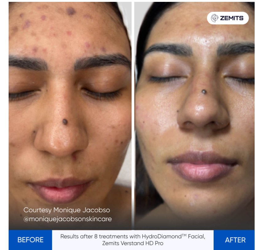 Zemits supplied before and after comparison: 8 treatments HydroDiamond Facial
