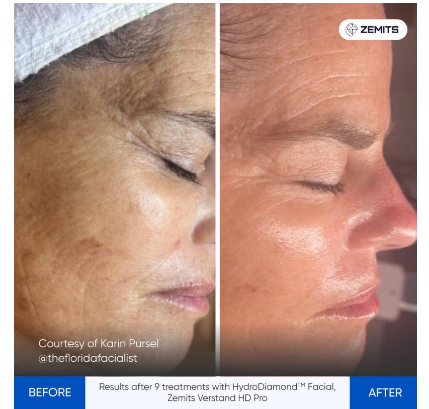 Zemits supplied before and after comparison: 9 treatments HydroDiamond Facial