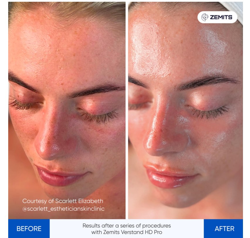 Zemits supplied before and after comparison: a series of treatments with the Zemits Verstand HD Pro